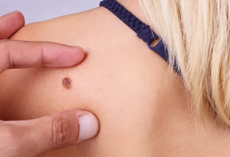 CÂNCER DE PELE: A importância do exame anatomopatológico