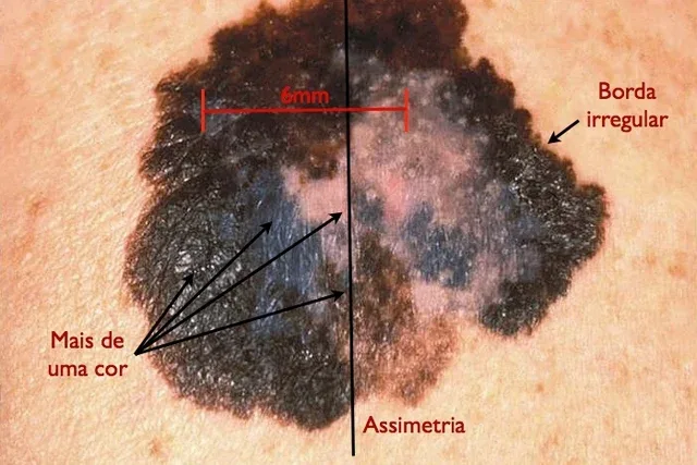 Sinais de alerta que devem ser avaliados por um dermatologista.